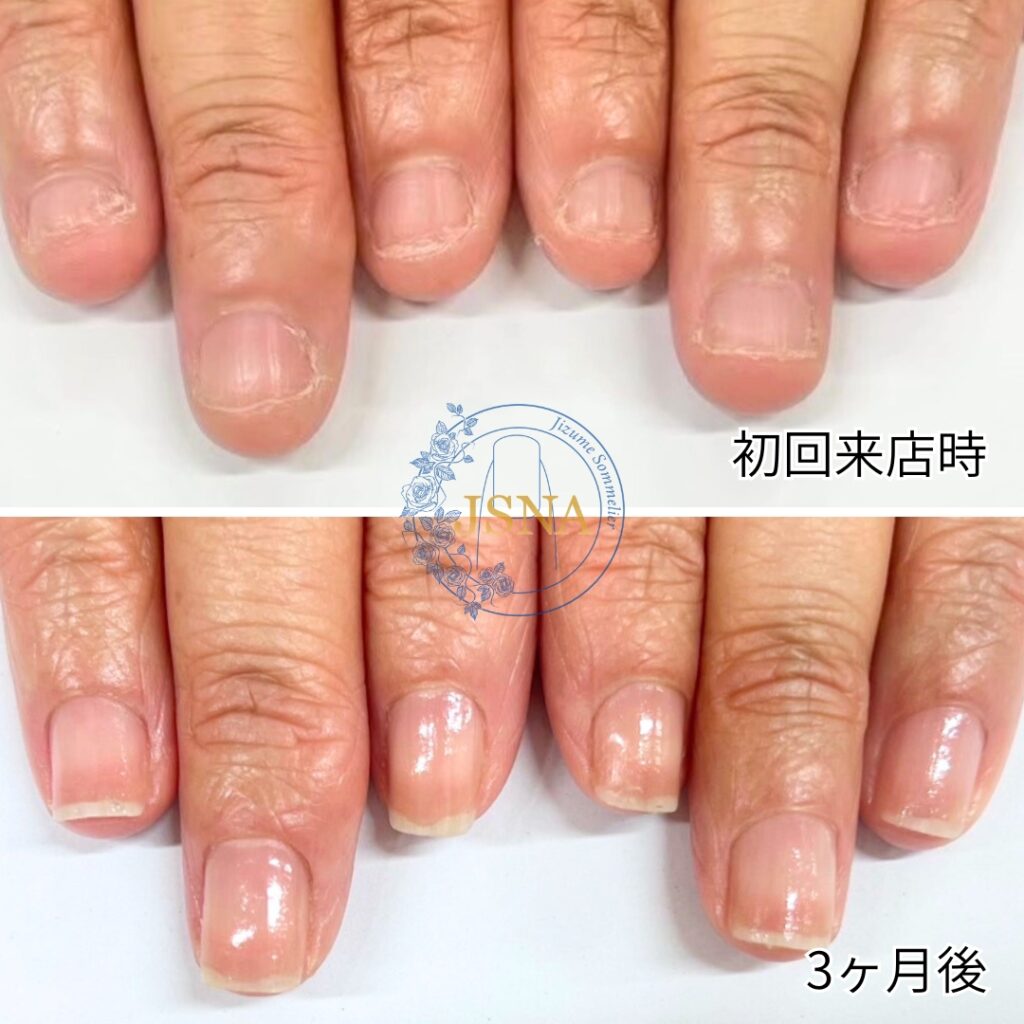 最強のネイルケア症例１