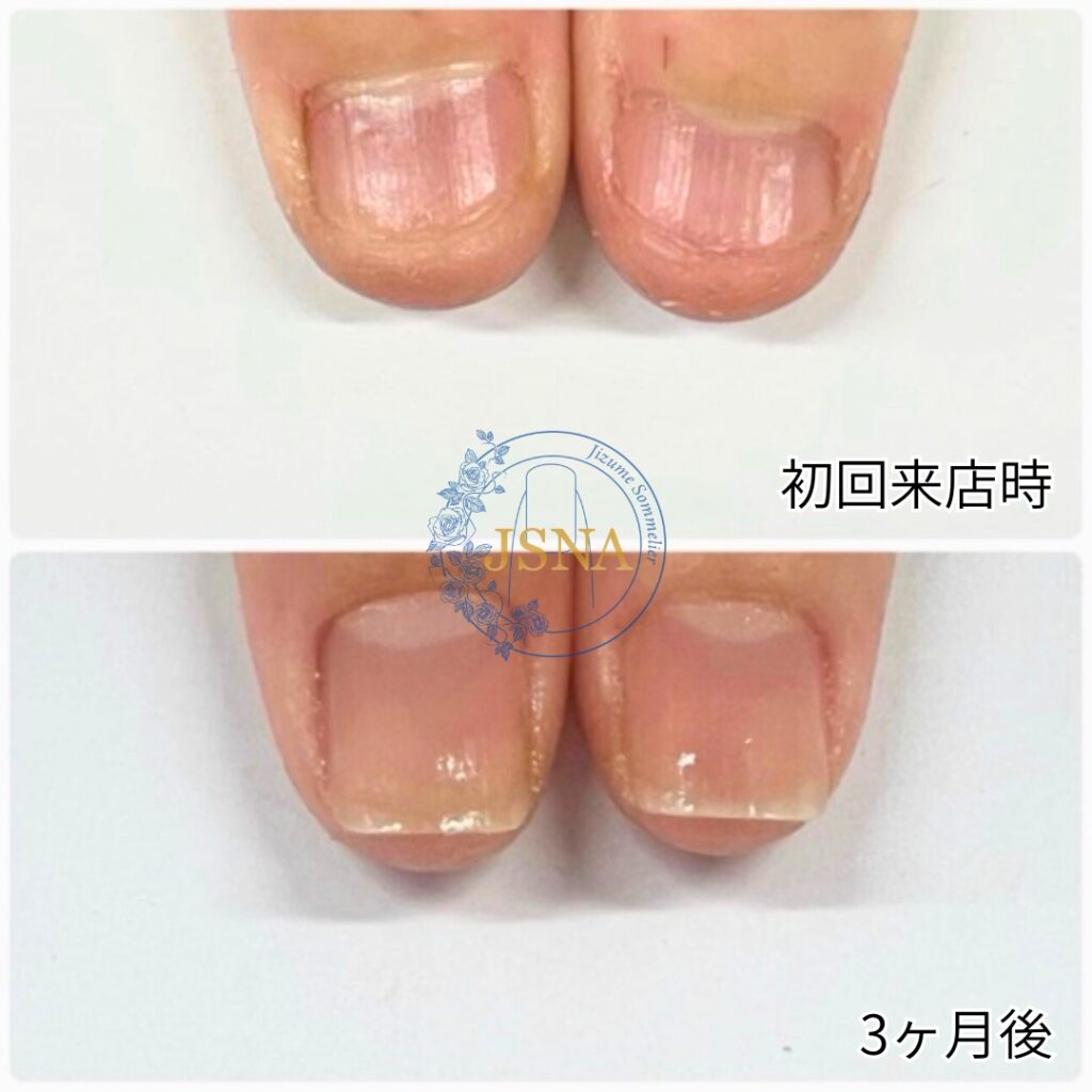 最強のネイルケア症例２