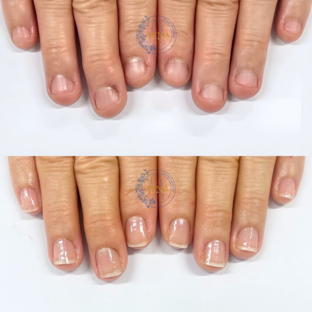 深爪の自爪育成症例