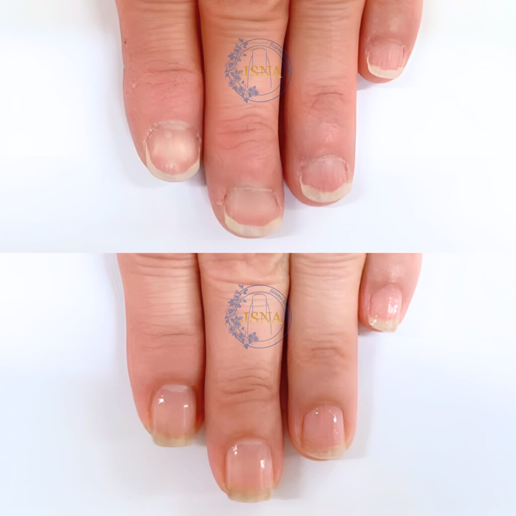 男爪、丸い爪の自爪育成症例