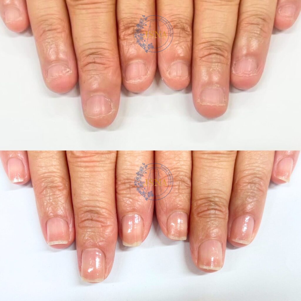 深爪の自爪育成症例